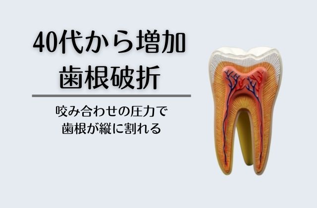 歯根破折で抜歯｜高松市の咬み合わせ歯科治療なら吉本歯科医院